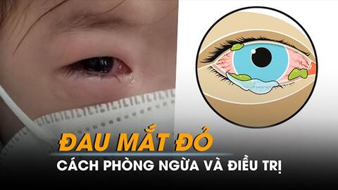 Chủ động phòng tránh bệnh đau mắt đỏ